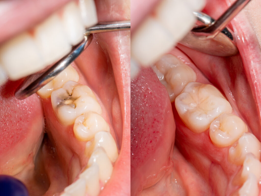 before and after dental composite fillings