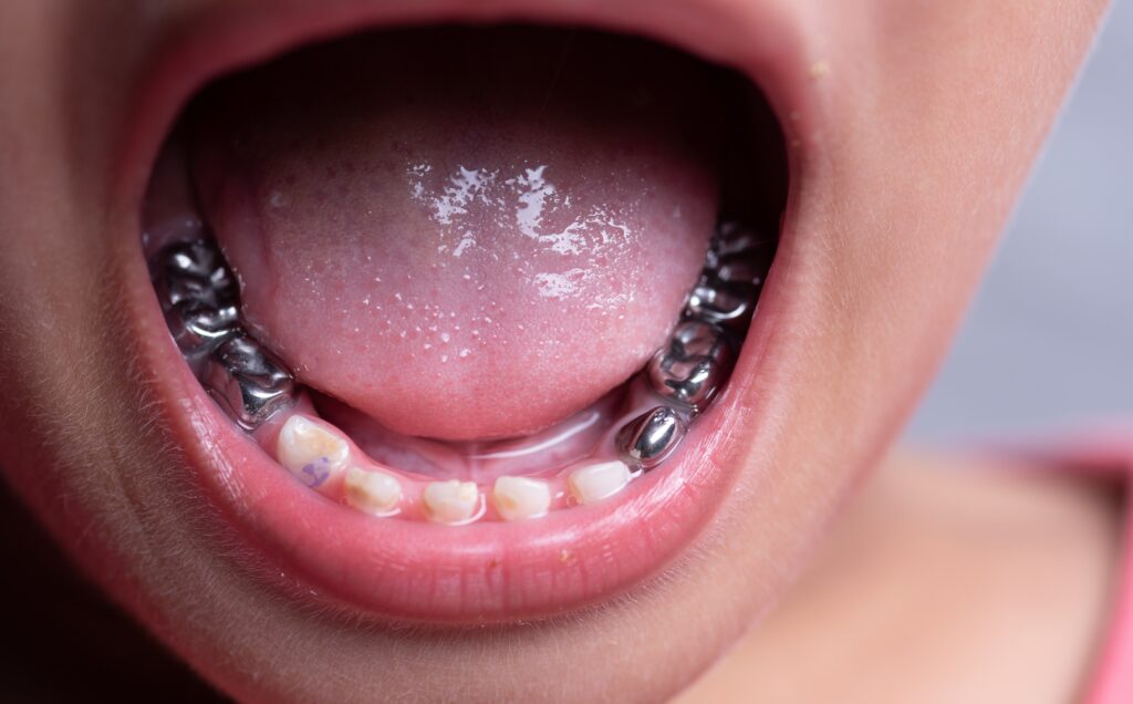 boy's mouth showing amalgam fillings