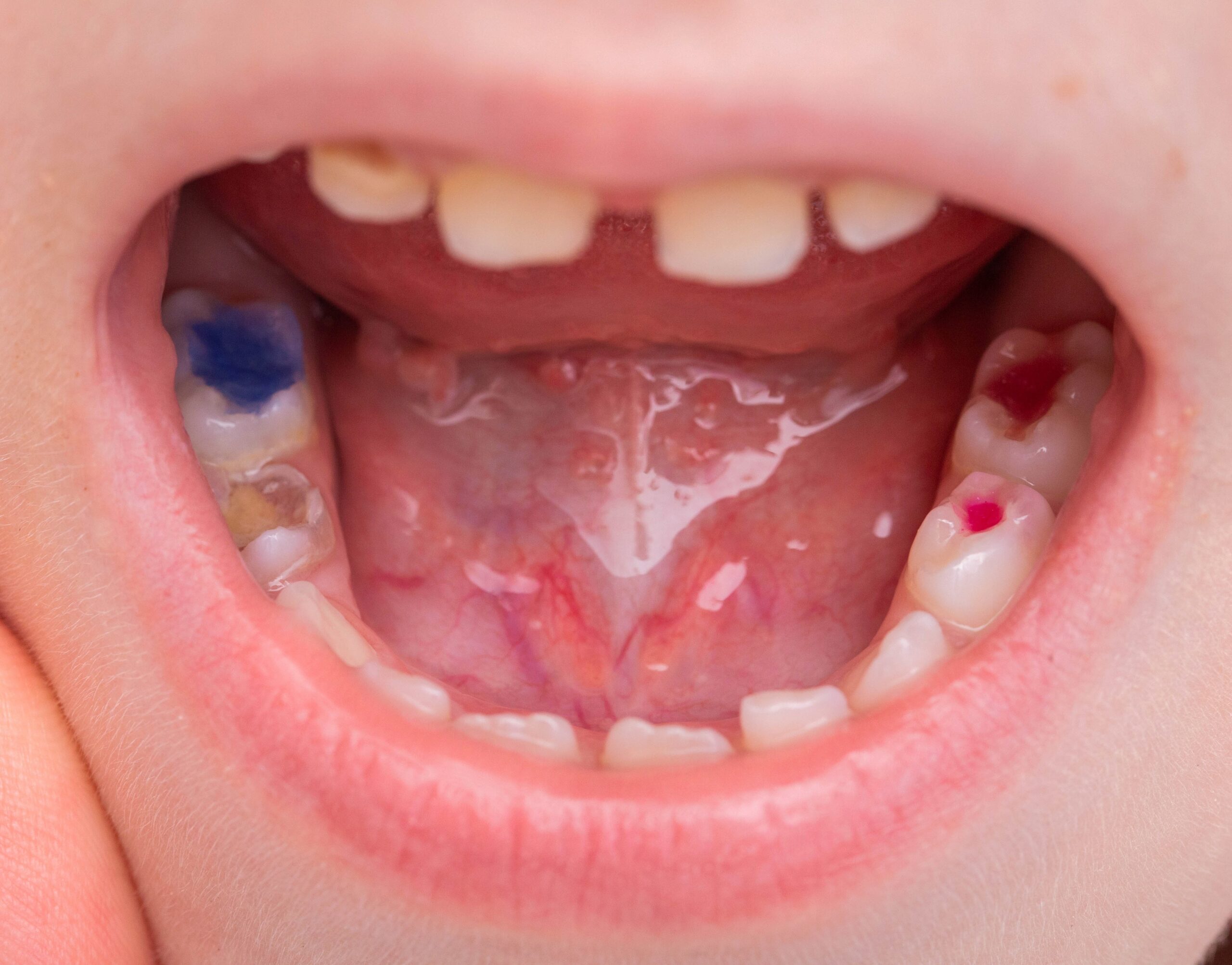 child's mouth showing fillings